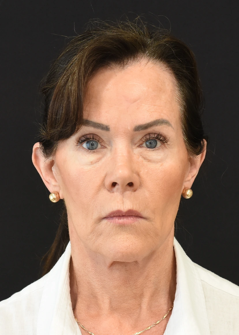 Deep Plane Facelift Patient 26 Set 1 After